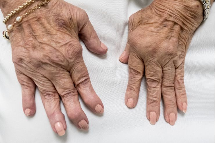 Rheumatoid Arthritis