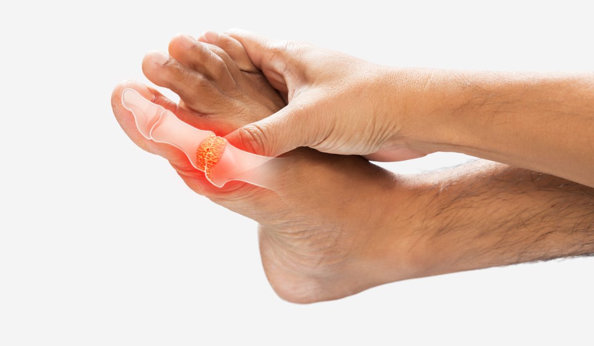 High levels of uric acid in men's toes bones on a gray background.